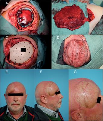 A Standard Algorithm for Reconstruction of Scalp Defects With Simultaneous Free Flaps in an Interdisciplinary Two-Team Approach